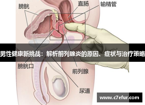 男性健康新挑战：解析前列腺炎的原因、症状与治疗策略